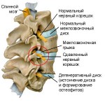 межпозвоночная грыжа лечение